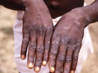 mpox india s kerala confirms south asia s first case of clade 1b mpox india s kerala confirms south asia s first case of clade 1b