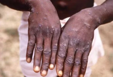 monkeypox mpox symptoms include fever rashes and swollen lymph nodes photo afp