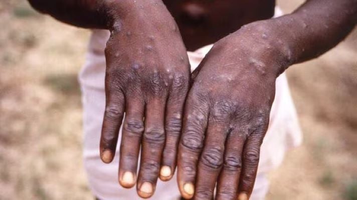 monkeypox mpox symptoms include fever rashes and swollen lymph nodes photo afp