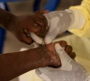 a laboratory nurse takes a sample from a child declared a suspected case of mpox photo reuters