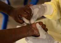 a laboratory nurse takes a sample from a child declared a suspected case of mpox photo reuters