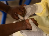 a laboratory nurse takes a sample from a child declared a suspected case of mpox photo reuters