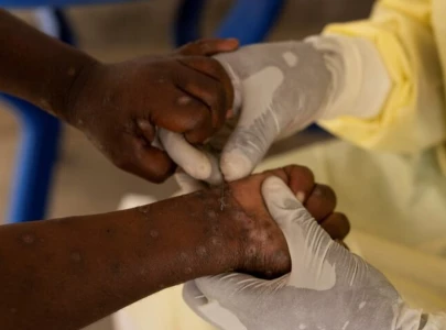 mpox claims another child s life in sindh this year s death toll rises to 12 mpox claims another child s life in sindh this year s death toll rises to 12