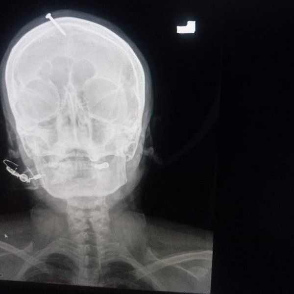 an image of the woman s x ray shows a nail lodged inside her skull photo express