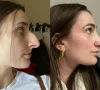tiktok influencer devyn aiken reveals how 11 000 nose job transformed her life