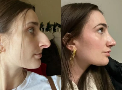 tiktok influencer devyn aiken reveals how 11 000 nose job transformed her life tiktok influencer devyn aiken reveals how 11 000 nose job transformed her life