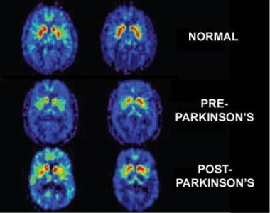 1 million patients of parkinson s disease in pakistan 1 million patients of parkinson s disease in pakistan
