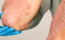 dry cold spell fuels disease surge