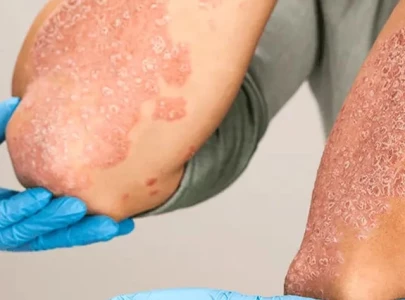 dry cold spell fuels disease surge