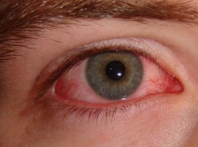 on alert drap recalls another eye medicine