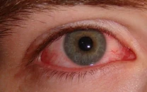 rawalpindi hospital treats 400 child eye cancer cases rawalpindi hospital treats 400 child eye cancer cases