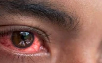 conjunctivitis outbreak sends eye drop rose water prices soaring in twin cities