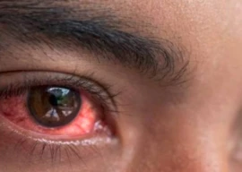 conjunctivitis outbreak sparks drug shortage conjunctivitis outbreak sparks drug shortage