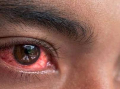 conjunctivitis outbreak sparks drug shortage conjunctivitis outbreak sparks drug shortage