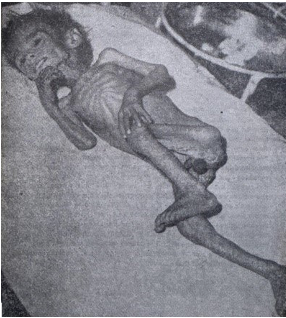 A child with Marasmus