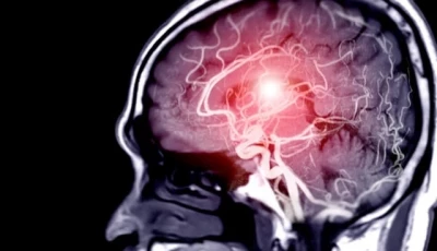 ucla scientists create drug that restores movement after stroke