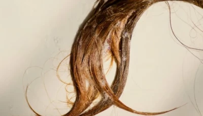struggling with hair fall 6 health issues that could be behind the breakage
