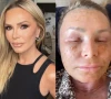 rhoc tamra judge shares dramatic post surgery swelling after co2 laser treatment