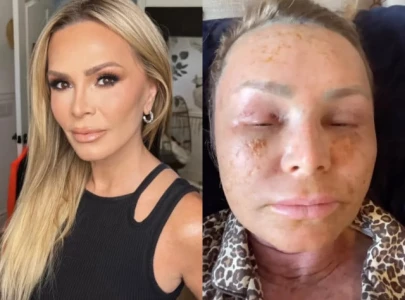 rhoc tamra judge shares dramatic post surgery swelling after co2 laser treatment