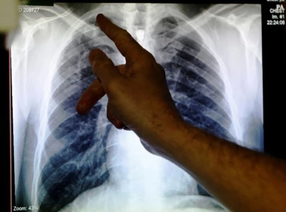 who reports record 8 2m tuberculosis cases globally in 2023 who reports record 8 2m tuberculosis cases globally in 2023