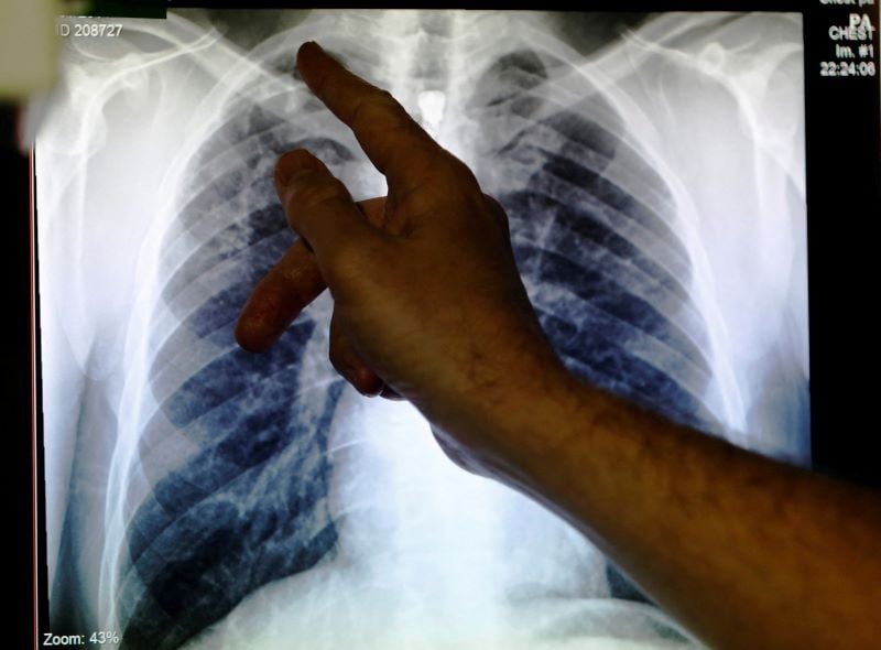 who reports record 8 2m tuberculosis cases globally in 2023