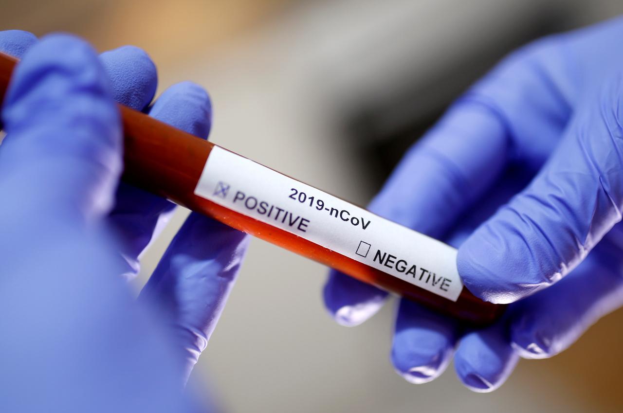 A Reuters file photo of a positive blood sample.