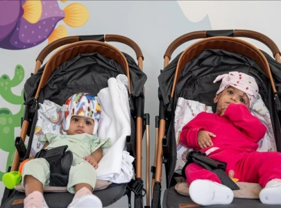 turkish doctors perform successful 14 hour surgery to separate conjoined twins from pakistan