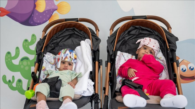 turkish doctors perform successful 14 hour surgery to separate conjoined twins from pakistan turkish doctors perform successful 14 hour surgery to separate conjoined twins from pakistan