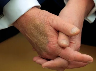 white house explains trump s bruised hand amid online speculation white house explains trump s bruised hand amid online speculation