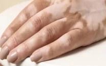 dermatologist raises vitiligo alert dermatologist raises vitiligo alert