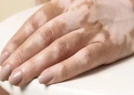 dermatologist raises vitiligo alert dermatologist raises vitiligo alert