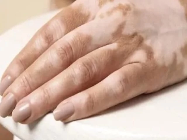 dermatologist raises vitiligo alert