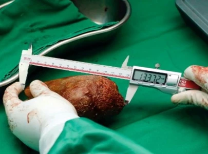 sri lanka doctors remove world s largest kidney stone