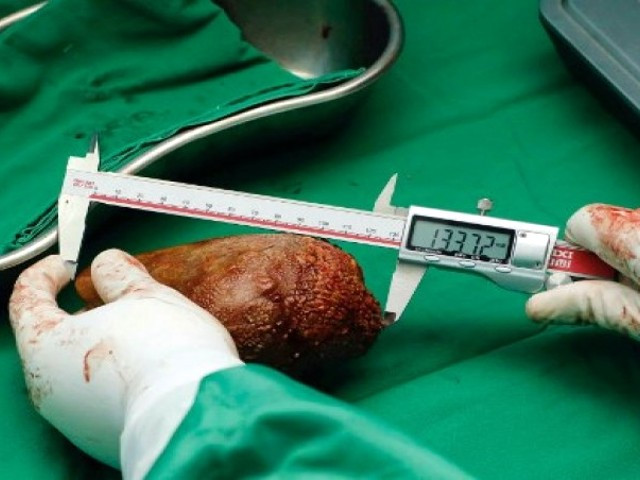 this handout photograph taken on june 1 2023 and released by the sri lankan army on june 14 2023 shows a military medical officer measuring a kidney stone removed from a retired soldier that weighed 801 grams 28 25 ounces and measured 13 37 centimetres 5 26 inches long at an army hospital in colombo photo afp