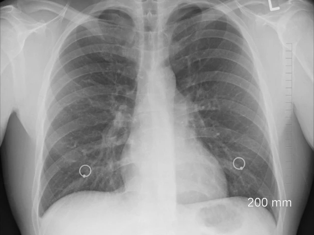 some 100 000 people worldwide are estimated to suffer from cystic fibrosis in which sticky mucus builds up in the lungs digestive tract and other parts of the body photo pixabay